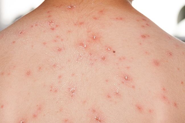 cacar-monyet-gejala-dan-cara-mencegah-penyakit-ini-0-alodokter